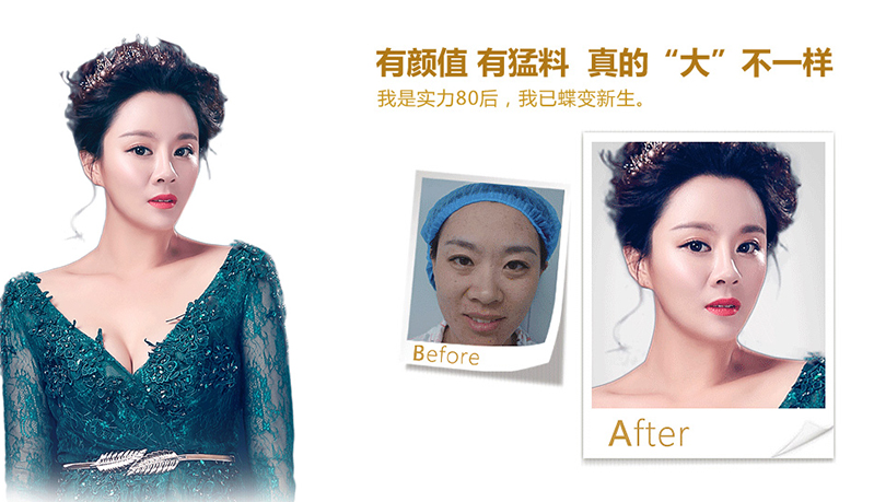 海南脂肪移植、隆鼻