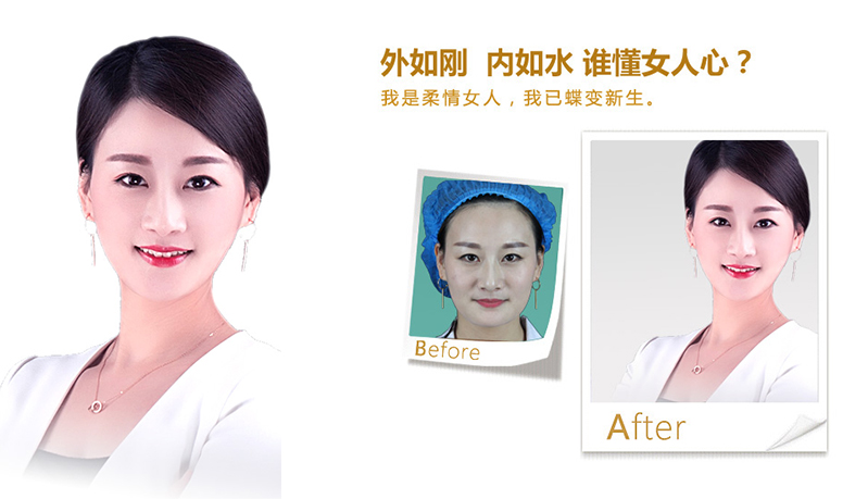 海南V脸、线雕隆鼻